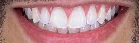 Clareamento-dental