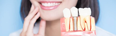 Implantes-Dentários